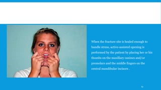 When the fracture site is healed enough to
handle stress, active-assisted opening is
performed by the patient by placing her or his
thumbs on the maxillary canines and/or
premolars and the middle fingers on the
central mandibular incisors .
87
 