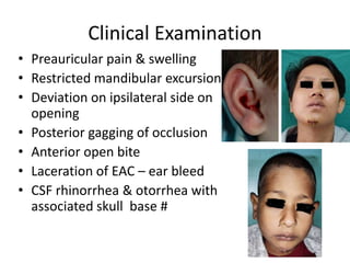 Clinical Examination
• Preauricular pain & swelling
• Restricted mandibular excursion
• Deviation on ipsilateral side on
opening
• Posterior gagging of occlusion
• Anterior open bite
• Laceration of EAC – ear bleed
• CSF rhinorrhea & otorrhea with
associated skull base #
 