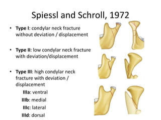 Spiessl and Schroll, 1972
• Type I: condylar neck fracture
without deviation / displacement
• Type II: low condylar neck fracture
with deviation/displacement
• Type III: high condylar neck
fracture with deviation /
displacement
IIIa: ventral
IIIb: medial
IIIc: lateral
IIId: dorsal
 
