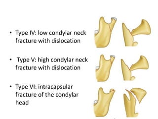 • Type IV: low condylar neck
fracture with dislocation
• Type V: high condylar neck
fracture with dislocation
• Type VI: intracapsular
fracture of the condylar
head
 