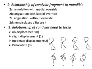• 2: Relationship of condylar fragment to mandible
2a: angulation with medial override
2b: angualtion with lateral override
2c: angulation without override
2d: nondisplaced / fissure #
• 3: Relationship of condylar head to fossa
 no displacement (0)
 slight displacement (1)
 moderate displacement(2)
 Dislocation (3)
 