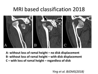 MRI based classification 2018
A- without loss of ramal height – no disk displacement
B- without loss of ramal height – with disk displacement
C – with loss of ramal height – regardless of disk
Ying et al. BJOMS(2018)
 