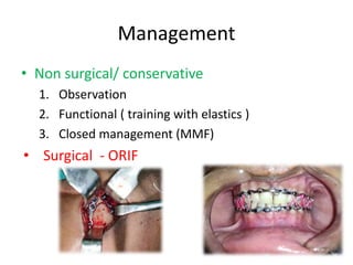 Management
• Non surgical/ conservative
1. Observation
2. Functional ( training with elastics )
3. Closed management (MMF)
• Surgical - ORIF
 