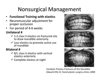 Nonsurgical Management
• Functional Training with elastics
• Neuromuscular adjustment for
proper occlusion
• For period of 4-6 weeks
Unilateral #
 1-2 class II elastics on fractured site
to draw mandible anteriorly.
 Less elastics to promote active use
of mandible
Bilateral #
 B/L class II elastics with vertical
elastics anteriorly
 Complete elastics at night
Condylar Process Fractures of the Mandible
Edward Ellis III, Facial plastic surgery clinics 2000
 
