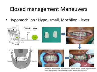 Closed management Maneuvers
• Hypomochlion : Hypo- small, Mochlion - lever
Thelekkat, Yeshaswini & Aravindakshan, shyam mohan. (2014). Hypomochlion
aided reduction for sub-condylar fractures. Kerala dental journal
Class III Lever
 