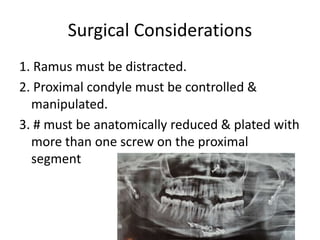 Surgical Considerations
1. Ramus must be distracted.
2. Proximal condyle must be controlled &
manipulated.
3. # must be anatomically reduced & plated with
more than one screw on the proximal
segment
 