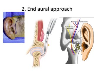 2. End aural approach
 