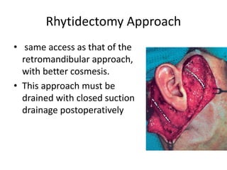 Rhytidectomy Approach
• same access as that of the
retromandibular approach,
with better cosmesis.
• This approach must be
drained with closed suction
drainage postoperatively
 