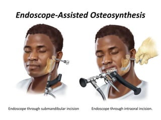 Endoscope-Assisted Osteosynthesis
Endoscope through submandibular incision Endoscope through intraoral incision.
 