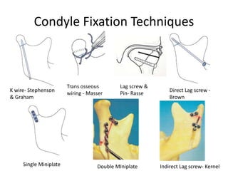 Condyle Fixation Techniques
Single Miniplate Double MIniplate Indirect Lag screw- Kernel
Direct Lag screw -
Brown
K wire- Stephenson
& Graham
Trans osseous
wiring - Masser
Lag screw &
Pin- Rasse
 