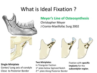 What is Ideal Fixation ?
Meyer’s Line of Osteosynthesis
Christopher Meyer
J Cranio-Maxillofac Surg 2002
Single Miniplate
Center/ Long axis of condyle
Close to Posterior Border
Two Miniplates
In Triangular Fashion
1st plate below Sigmoid Notch
2nd plate Along Posterior Border
Fixation with specific
implants for the
subcondylar region.
 