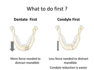 What to do first ?
Dentate First
More force needed to
distract mandible
Condyle First
Less force needed to distract
mandible
Condyle reduction is easier
 