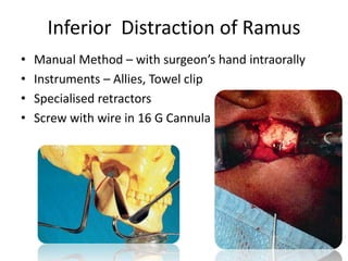 Inferior Distraction of Ramus
• Manual Method – with surgeon’s hand intraorally
• Instruments – Allies, Towel clip
• Specialised retractors
• Screw with wire in 16 G Cannula
 