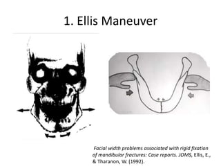 1. Ellis Maneuver
Facial width problems associated with rigid fixation
of mandibular fractures: Case reports. JOMS, Ellis, E.,
& Tharanon, W. (1992).
 