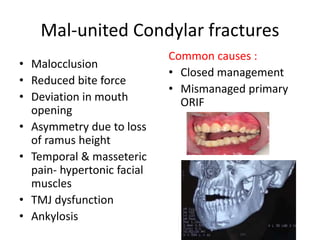 Mal-united Condylar fractures
• Malocclusion
• Reduced bite force
• Deviation in mouth
opening
• Asymmetry due to loss
of ramus height
• Temporal & masseteric
pain- hypertonic facial
muscles
• TMJ dysfunction
• Ankylosis
Common causes :
• Closed management
• Mismanaged primary
ORIF
 