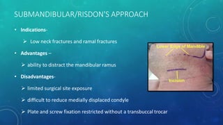 Condylar fractures | PPTX