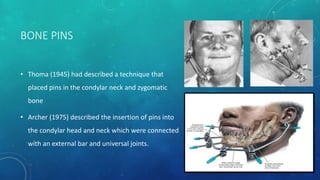 Condylar fractures | PPTX