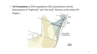 CONDYLAR FRACTURES AND ITS MANAGEMENT.pptx