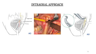 Condyle Lift CONDYLAR FRACTURES AND ITS MANAGEMENT.pptx