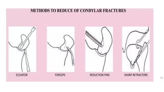 Condyle Lift CONDYLAR FRACTURES AND ITS MANAGEMENT.pptx