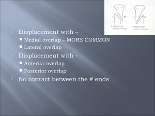  Displacement with –
 Medial overlap – MORE COMMON
 Lateral overlap
 Displacement with –
 Anterior overlap
 Posterior overlap
 No contact between the # ends
 