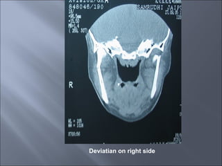 Deviatian on right side
 