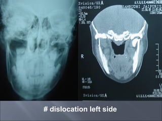 # dislocation left side
 