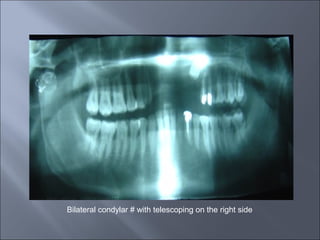 Bilateral condylar # with telescoping on the right side
 