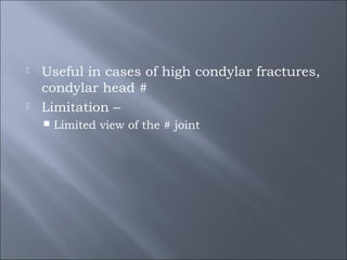  Useful in cases of high condylar fractures,
condylar head #
 Limitation –
 Limited view of the # joint
 