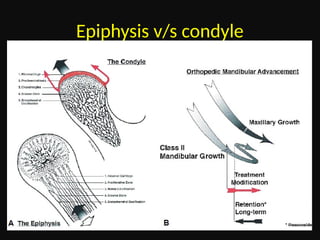 Condyle Lift condylar growth in orthodontics and dentofacial orthopaedics | PPTX