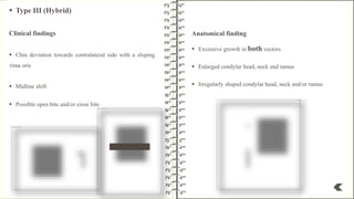 Condylar Hyperplasia and Othodontics.pptx
