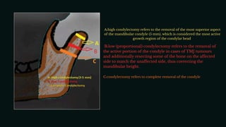 Condyle Lift Condylar hyperplasia is a rare, benign bone disorder characterized by ...