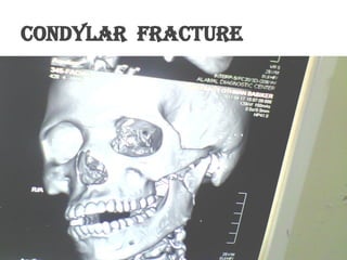 Condylar fracture
 