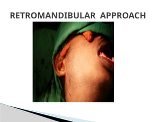 RETROMANDIBULAR APPROACH
 