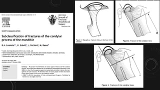 Management of Mandibular Condyle fracture | PPTX