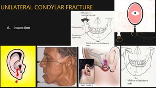 Management of Mandibular Condyle fracture | PPTX