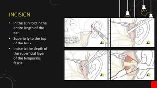 Management of Mandibular Condyle fracture | PPTX