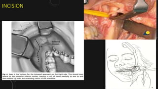 Management of Mandibular Condyle fracture | PPTX