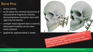 Management of Mandibular Condyle fracture | PPTX