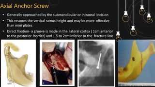 Management of Mandibular Condyle fracture | PPTX