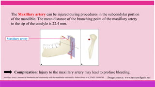 The Maxillary artery can be injured during procedures in the subcondylar portion
of the mandible. The mean distance of the branching point of the maxillary artery
to the tip of the condyle is 22.4 mm.
Maxillary artery
Maxillary artery: anatomical landmarks and relationship with the mandibular subcondyle, Hakan Orbay et al, PMID: 18090748 Image source: www.researchgate.net
Complication: Injury to the maxillary artery may lead to profuse bleeding.
 