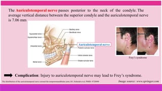 The Auriculotemporal nerve passes posterior to the neck of the condyle. The
average vertical distance between the superior condyle and the auriculotemporal nerve
is 7.06 mm
Auriculotemporal nerve
The distribution of the auriculotemporal nerve around the temporomandibular joint, B L Schmidt et al, PMID: 9720090 Image source: www.springer.com
Complication: Injury to auriculotemporal nerve may lead to Frey’s syndrome.
Frey’s syndrome
 