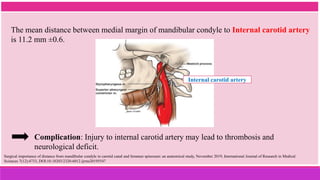 The mean distance between medial margin of mandibular condyle to Internal carotid artery
is 11.2 mm ±0.6.
Surgical importance of distance from mandibular condyle to carotid canal and foramen spinosum: an anatomical study, November 2019, International Journal of Research in Medical
Sciences 7(12):4733, DOI:10.18203/2320-6012.ijrms20195547
Internal carotid artery
Complication: Injury to internal carotid artery may lead to thrombosis and
neurological deficit.
 