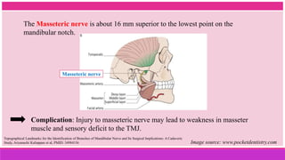 The Masseteric nerve is about 16 mm superior to the lowest point on the
mandibular notch.
Masseteric nerve
Topographical Landmarks for the Identification of Branches of Mandibular Nerve and Its Surgical Implications: A Cadaveric
Study, Ariyanachi Kaliappan et al, PMID: 34984156 Image source: www.pocketdentistry.com
Complication: Injury to masseteric nerve may lead to weakness in masseter
muscle and sensory deficit to the TMJ.
 