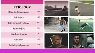 Road traffic accidents 45%
Fall injury 40%
Interpersonal violence 8%
Sports injury 3%
Crushing trauma 2%
Gun shot <1%
Pathological process <1%
ETIOLOGY
 