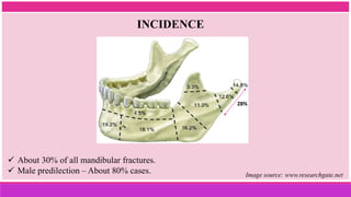 INCIDENCE
 About 30% of all mandibular fractures.
 Male predilection – About 80% cases. Image source: www.researchgate.net
28%
 