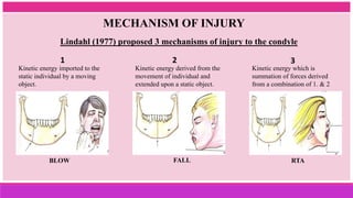BLOW FALL RTA
Kinetic energy imported to the
static individual by a moving
object.
Lindahl (1977) proposed 3 mechanisms of injury to the condyle
MECHANISM OF INJURY
Kinetic energy derived from the
movement of individual and
extended upon a static object.
Kinetic energy which is
summation of forces derived
from a combination of 1. & 2
1 2 3
 