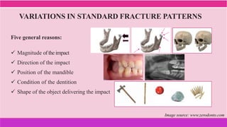 VARIATIONS IN STANDARD FRACTURE PATTERNS
Five general reasons:
 Magnitude oftheimpact
 Direction of the impact
 Position of the mandible
 Condition of the dentition
 Shape of the object delivering the impact
Image source: www.zerodonto.com
 