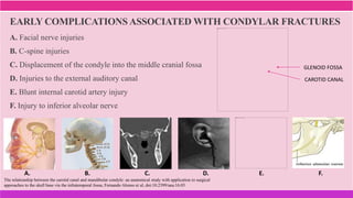 A. Facial nerve injuries
B. C-spine injuries
C. Displacement of the condyle into the middle cranial fossa
D. Injuries to the external auditory canal
E. Blunt internal carotid artery injury
F. Injury to inferior alveolar nerve
EARLY COMPLICATIONS ASSOCIATED WITH CONDYLAR FRACTURES
A. B. C. D. E. F.
The relationship between the carotid canal and mandibular condyle: an anatomical study with application to surgical
approaches to the skull base via the infratemporal fossa, Fernando Alonso et al, doi:10.2399/ana.16.03
GLENOID FOSSA
CAROTID CANAL
 