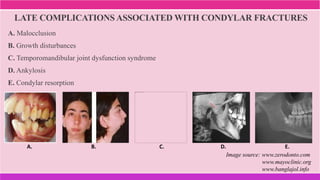 LATE COMPLICATIONS ASSOCIATED WITH CONDYLAR FRACTURES
A. Malocclusion
B. Growth disturbances
C. Temporomandibular joint dysfunction syndrome
D. Ankylosis
E. Condylar resorption
A. B. C. D. E.
Image source: www.zerodonto.com
www.mayoclinic.org
www.banglajol.info
 